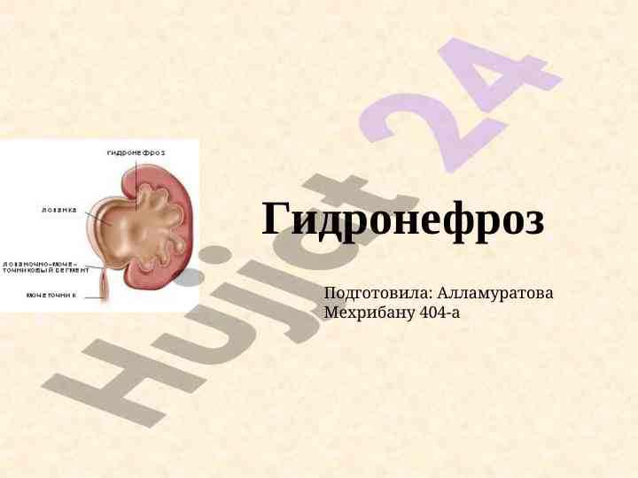 Гидронефроз: основные причины и классификация заболевания