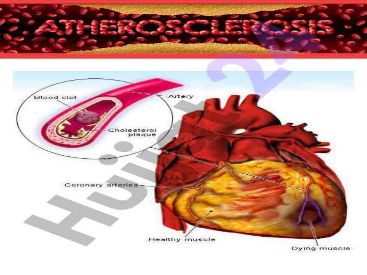 Ateroskleroz epidemiologiyasining muhim asoslari