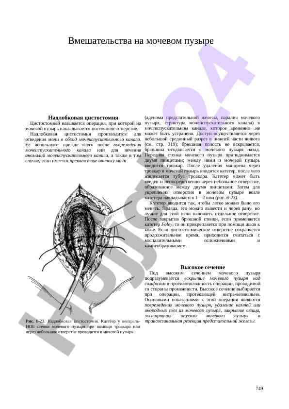 Nadlobkovaya tsistostomiya: vmeshatel'stva na moshevom puzire